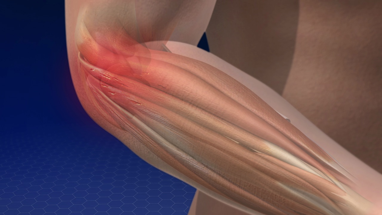 tendonitis of the elbow